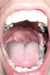 Better understanding of ‘mouth microbes’ may improve oral health treatments