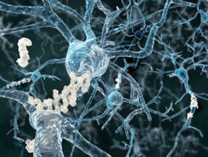 New Alzheimer’s drug shows promise, but don’t celebrate yet