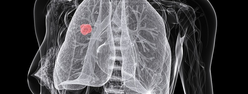 Lung cancer screening guidelines may lead to more disparities