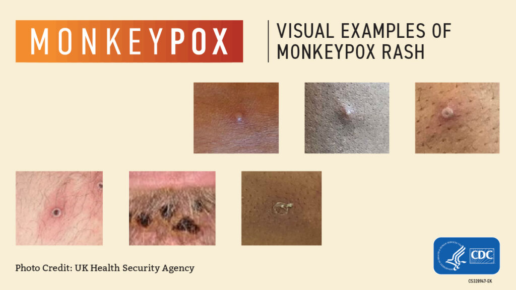 The latest on monkeypox: rates, preparedness