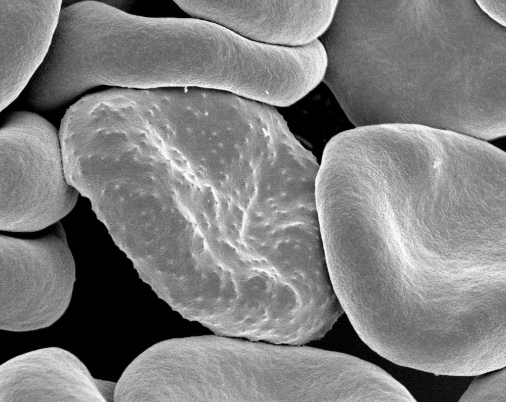red blood cells infected with malaria