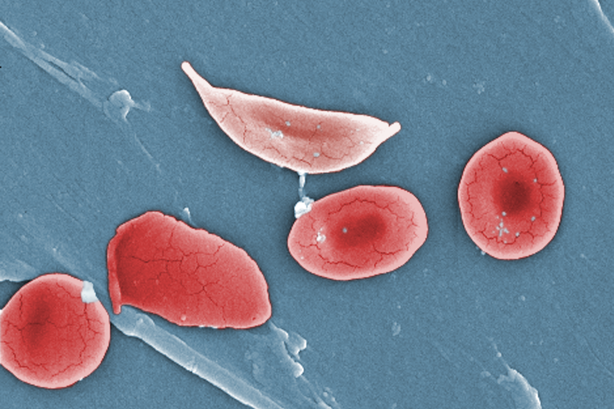 microscope image of healthy blood cells next to the blood cell of someone with sickle cell anemia