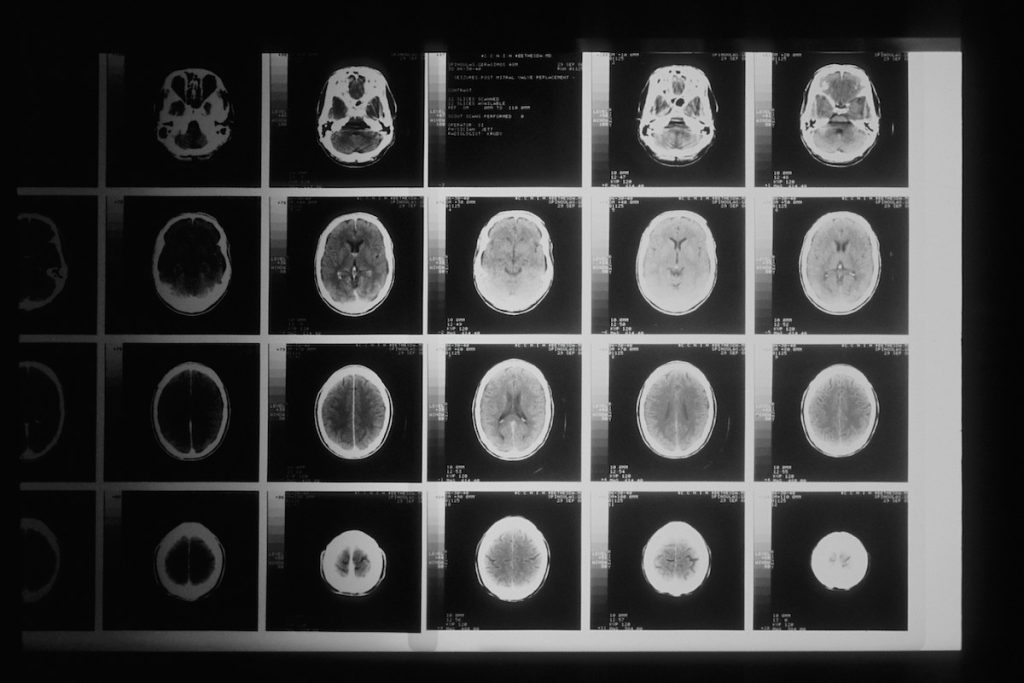 a head x-ray taken by a CT scanner. Alzheimer's featured image