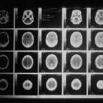 a head x-ray taken by a CT scanner. Alzheimer's featured image