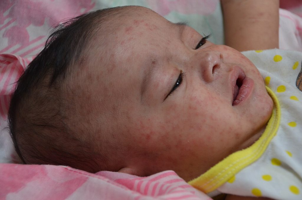 a baby with measles in 2014