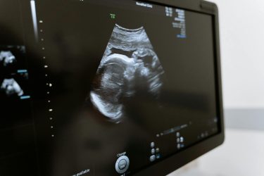 ultrasound image of fetus