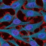 Cervical Cancer cells