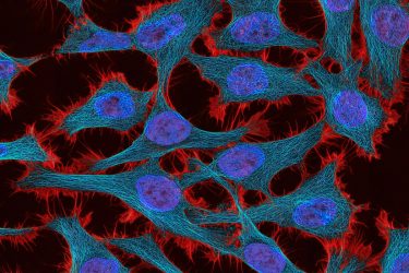 Cervical Cancer cells